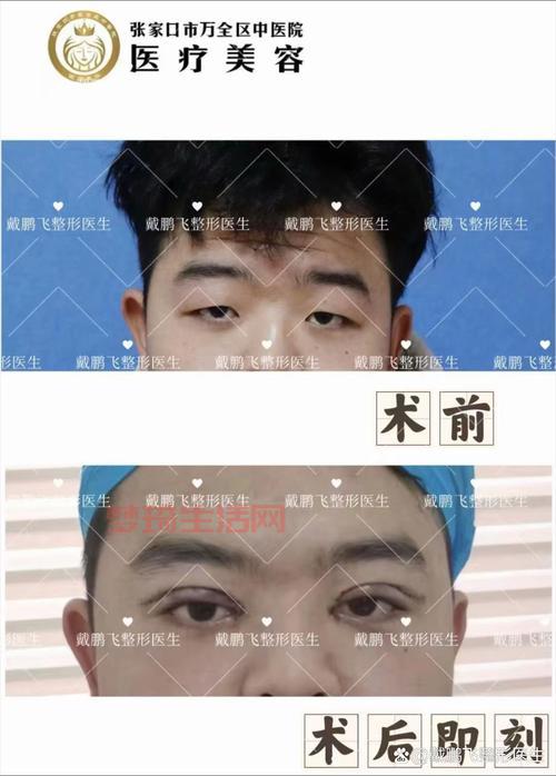 蒙古褶和双眼皮有啥关系？这篇文章告诉你答案！
