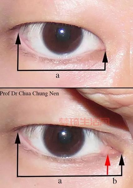 蒙古褶和双眼皮有啥关系？这篇文章告诉你答案！