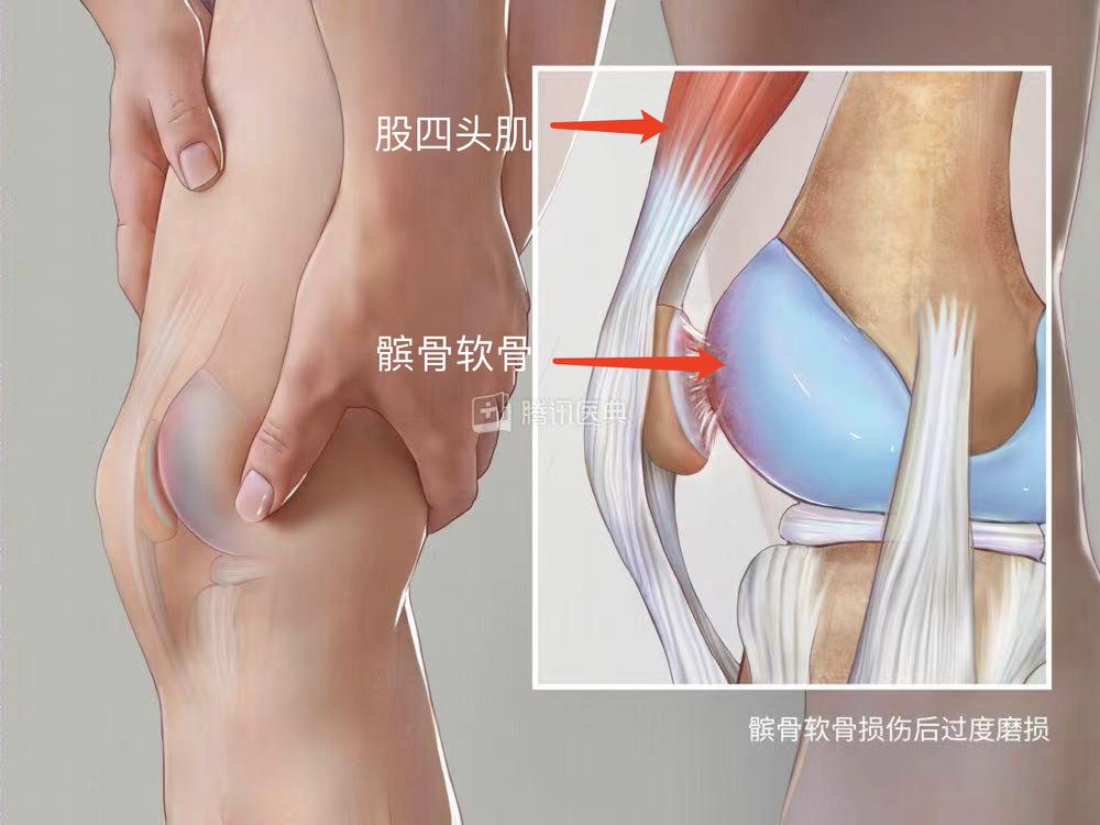 走路时为什么膝盖会突然软一下_髌骨软化症原因_髌骨软骨软化症症状