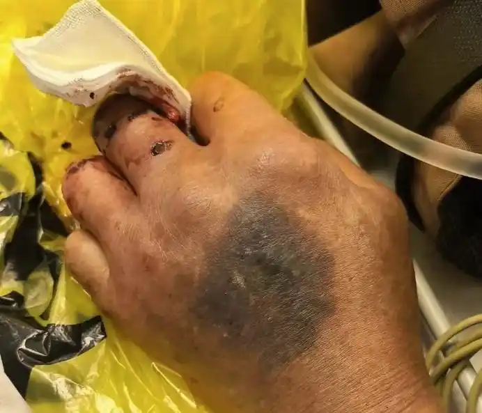 男子遭不明毒蛇咬伤，心跳骤停！然而抢救陷入僵局……