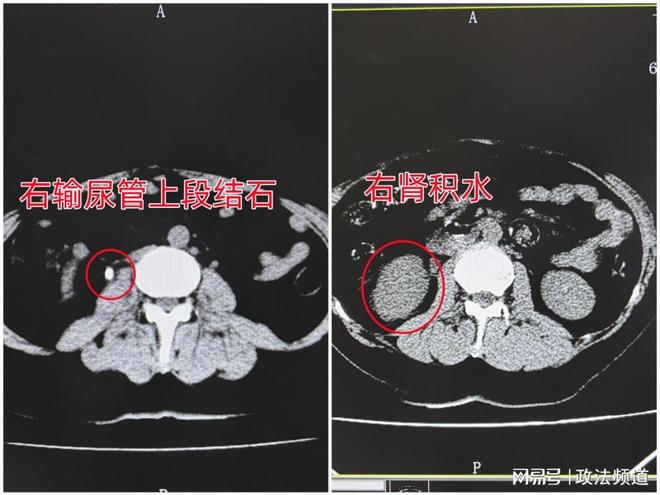 女子为生计奔波常憋尿，突发呕吐才知结石梗阻尿路