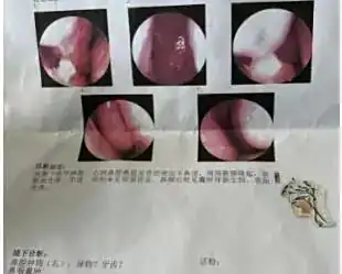 鼻腔多生牙_鼻内异物感多生牙_男子鼻窦炎多年竟是3厘米树枝藏鼻中