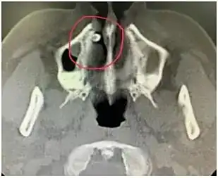 鼻内异物感多生牙_鼻腔多生牙_男子鼻窦炎多年竟是3厘米树枝藏鼻中