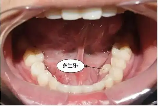 鼻内异物感多生牙_鼻腔多生牙_男子鼻窦炎多年竟是3厘米树枝藏鼻中