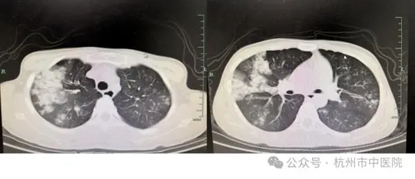 发烧2天，杭州小伙肺部大面积变白！送进重症监护室！医生：千万别硬扛