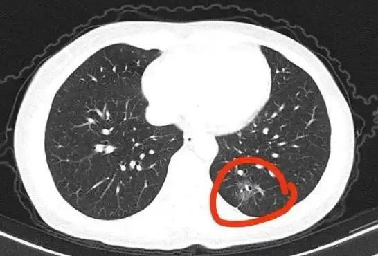 柯炜林确诊肺腺癌_29岁男星确诊癌症晚期_肺腺癌晚期治疗