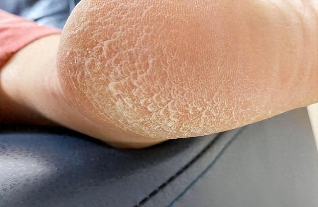 角化型脚气治疗_角化型脚气症状_股藓 用什么洗澡