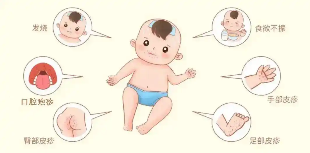 秋季手足口病高发防护措施_河南手足口病CA16型CA6型症状差异_河南省疾控发布重要提醒