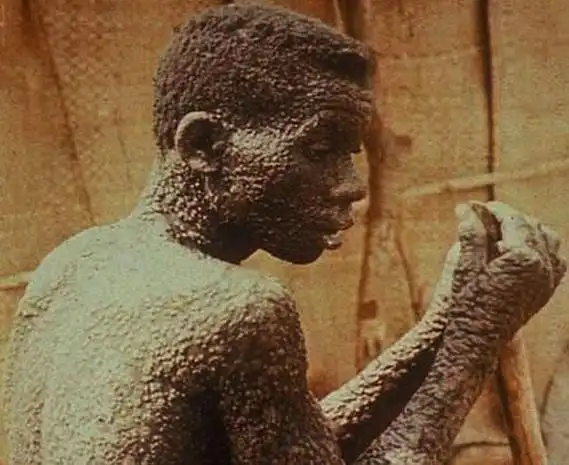 埃博拉病毒时事评论_埃博拉病毒自然宿主蝙蝠研究_刚果埃博拉疫情最新进展