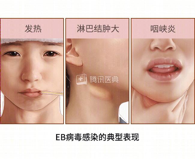 EB病毒感染_美国爆发“接吻虫病”疫情_亲吻病
