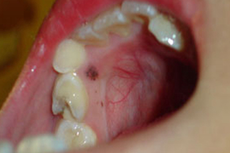 口腔内壁黑色素瘤图片