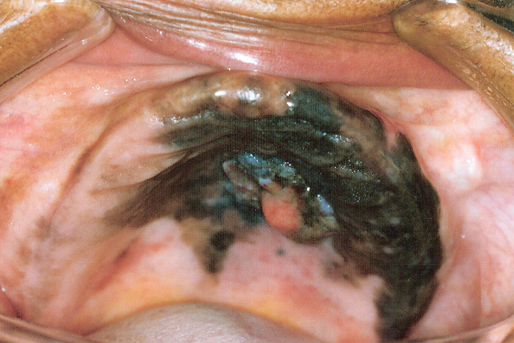 口腔内壁黑色素瘤肿块图