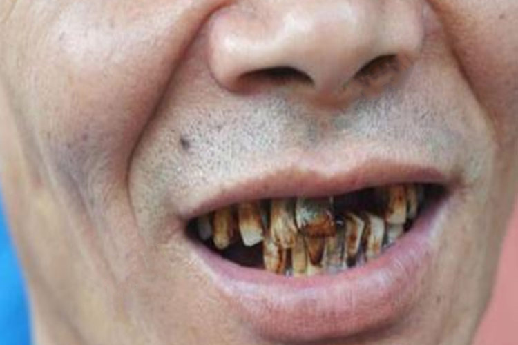 牙齿表面有黑斑图片