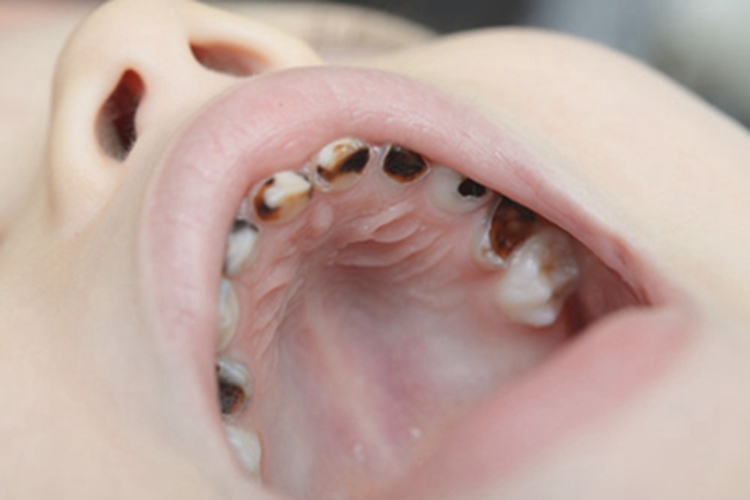 小儿龋齿黑斑图片