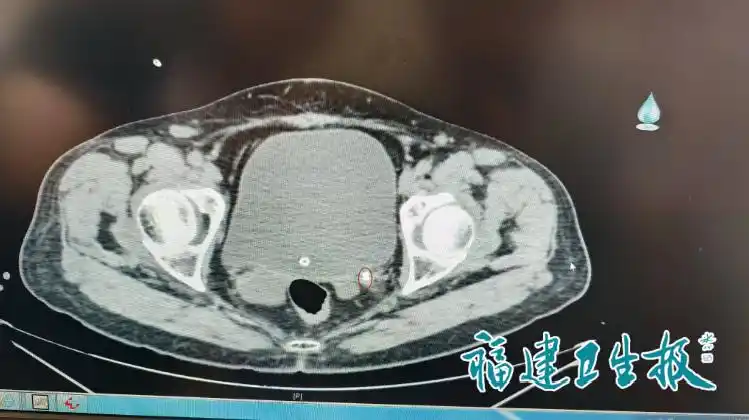 夏季预防肾结石_肾结石症状与治疗_女子患肾结石 老公帮忙倒立排结石
