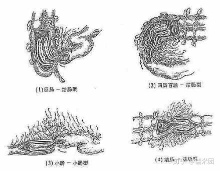 小儿肠套叠症状_小儿尿失禁原因_小儿肠套叠诊断