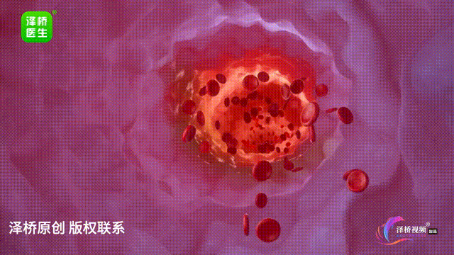 脑梗年轻化预警!4个身体信号千万别忽视 脑梗年轻化预警!4个身体信号千万别忽视
